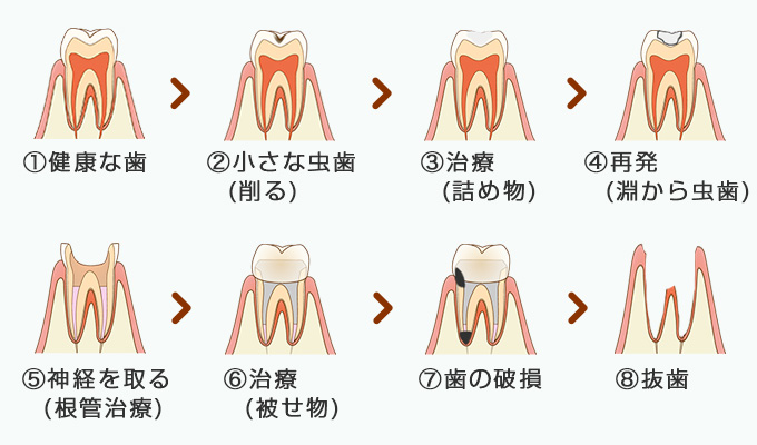 むし歯と抜歯のサイクル イメージ画像